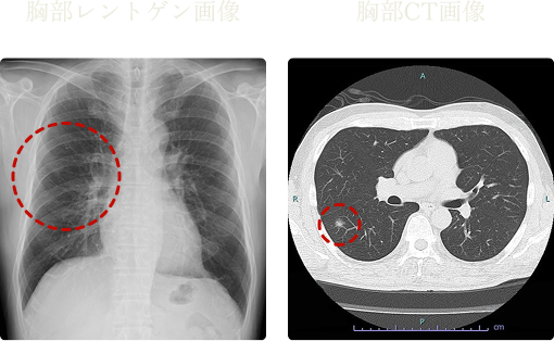 胸部レントゲン、胸部CTの画像