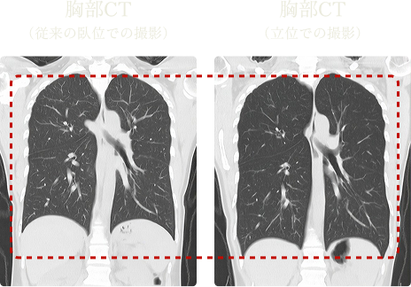 胸部CT（従来の臥位での撮影）、胸部CT（立位での撮影）の画像