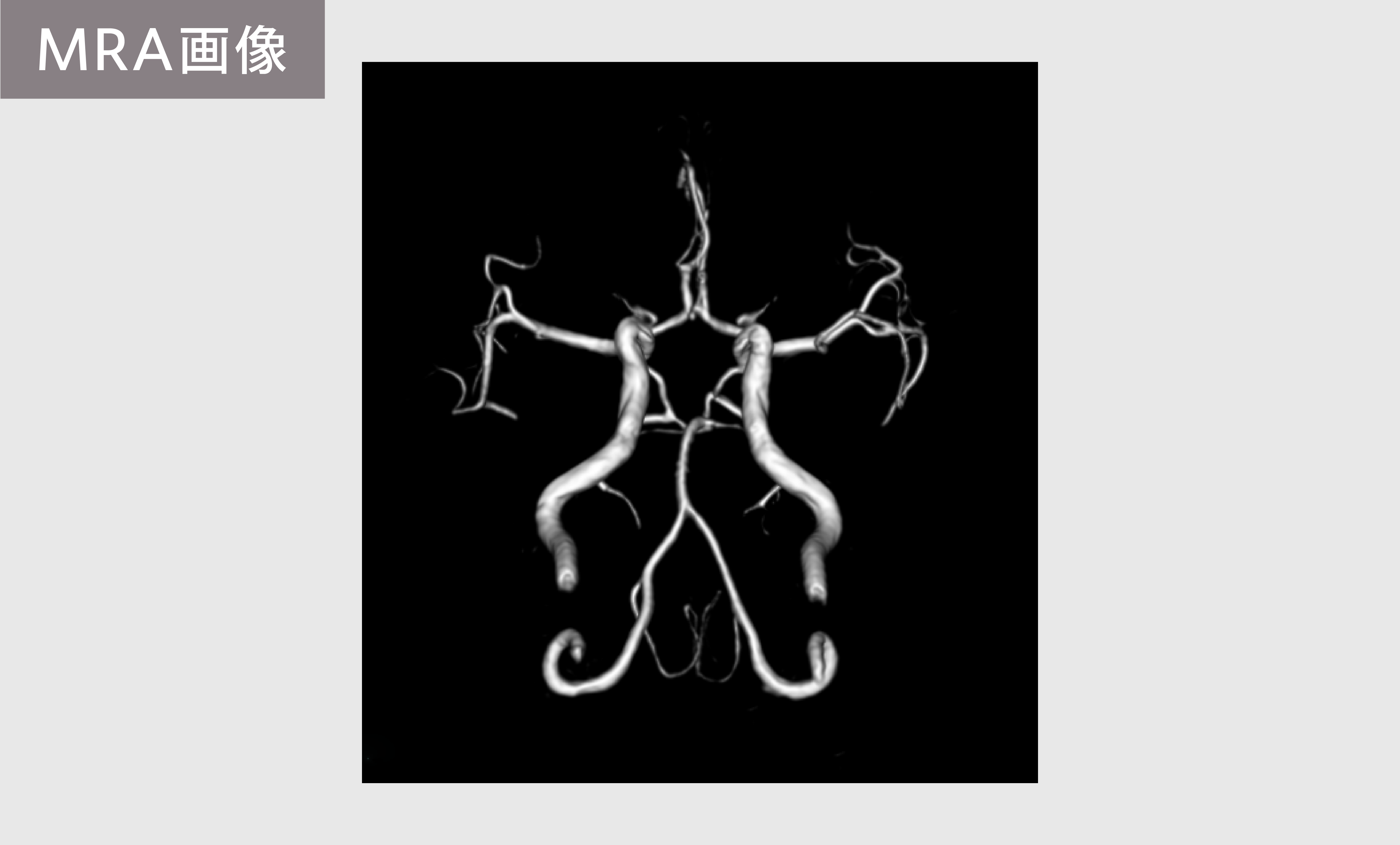 MRA画像