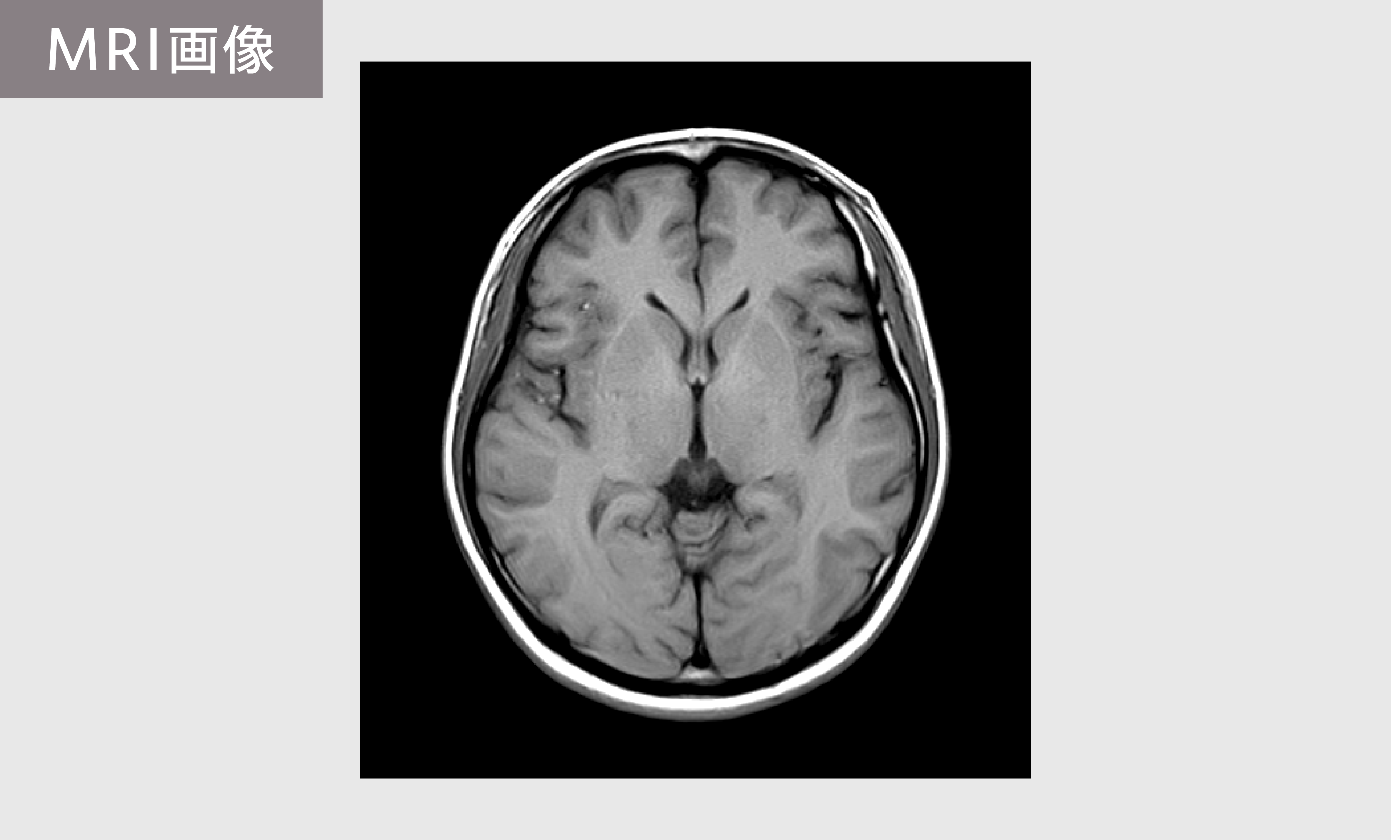 MRI画像