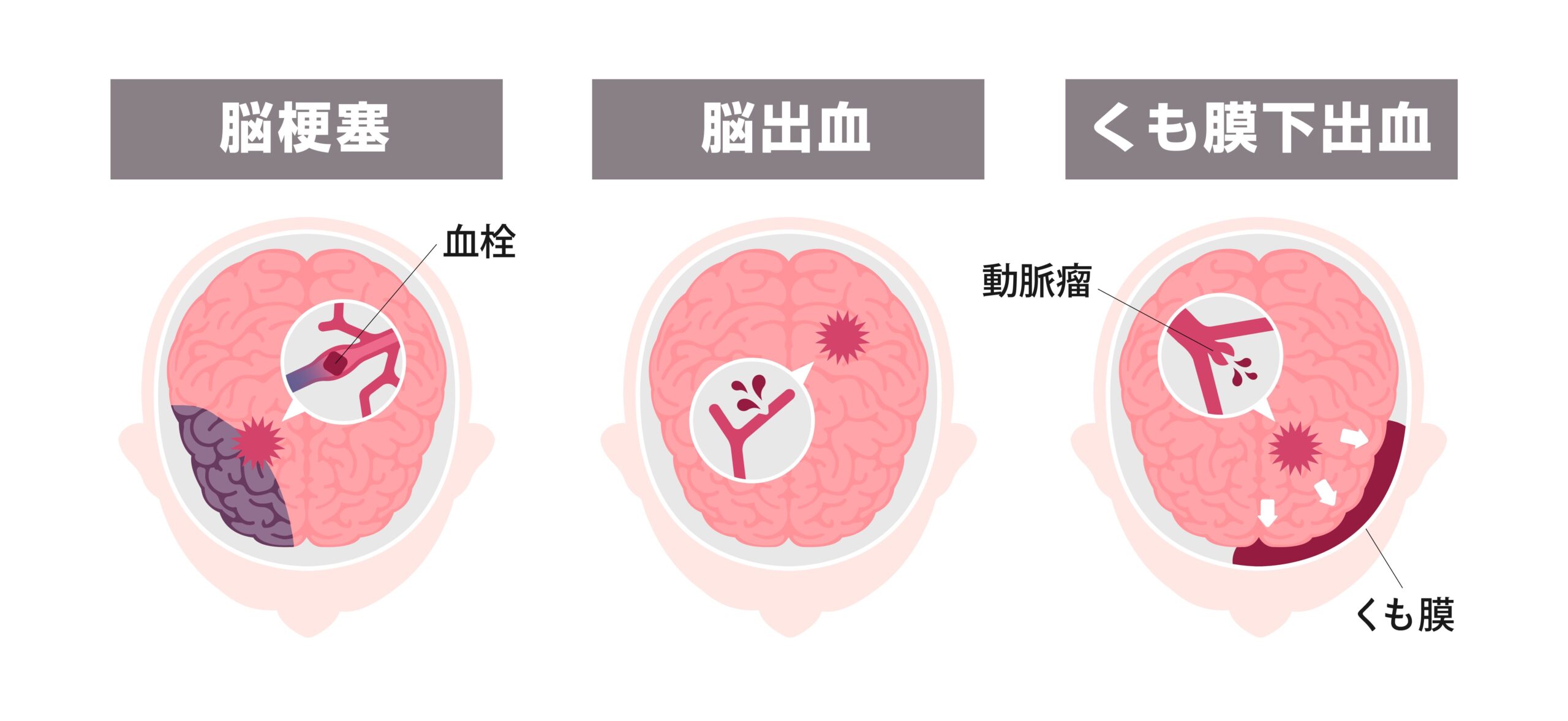 脳卒中の主な種類
