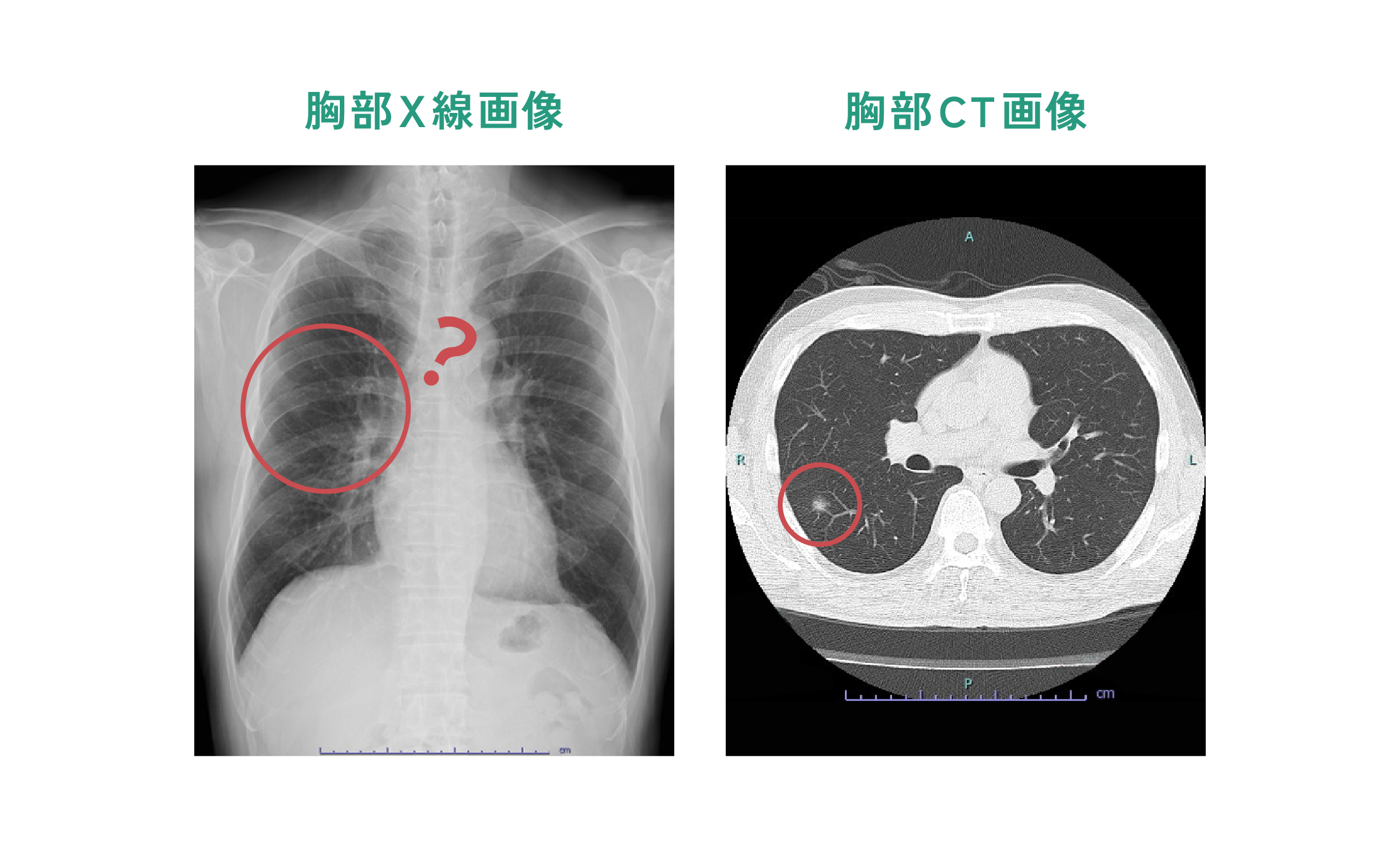 胸部レントゲン画像・胸部CT画像 比較