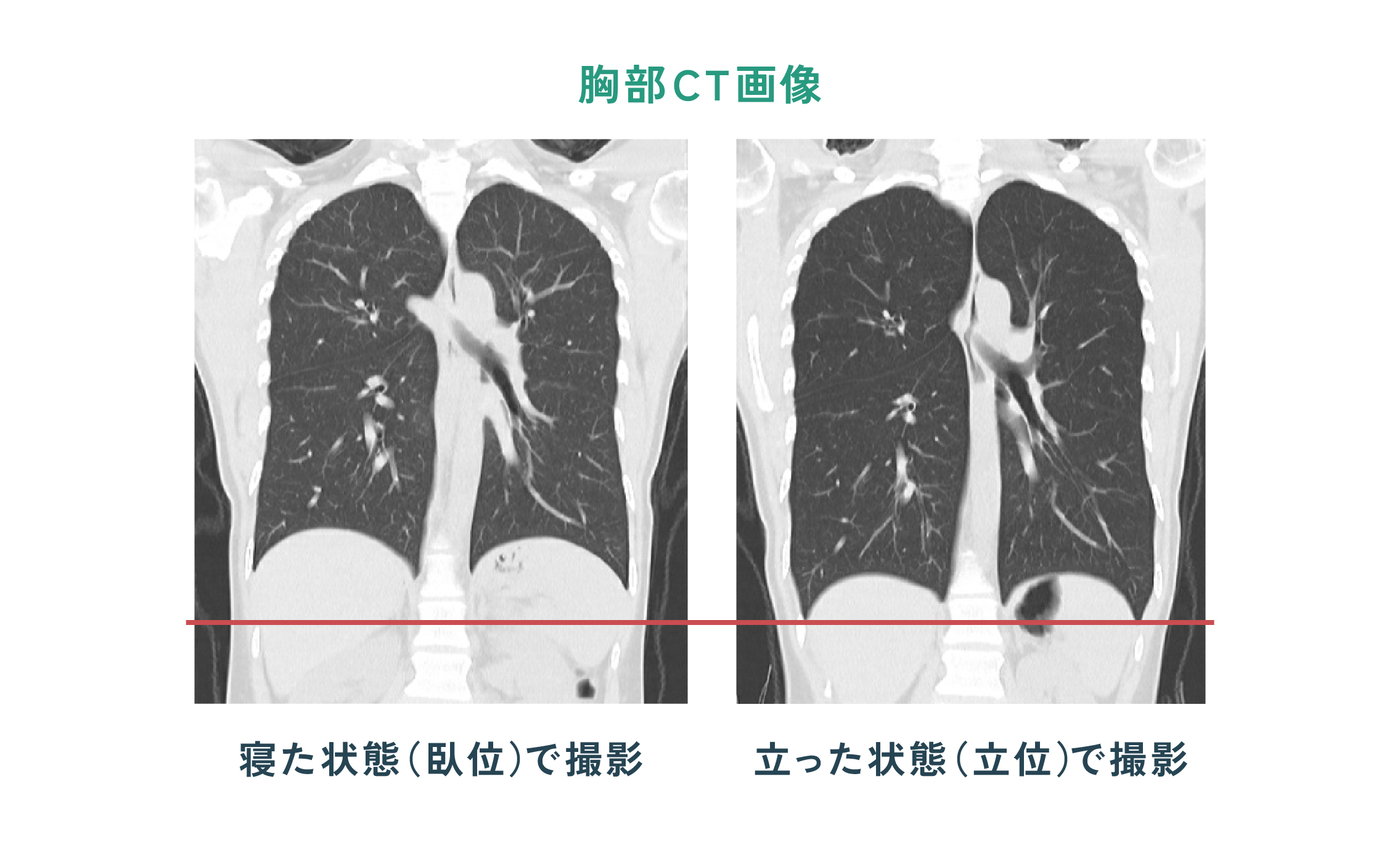 胸部CT画像・立位と臥位 比較